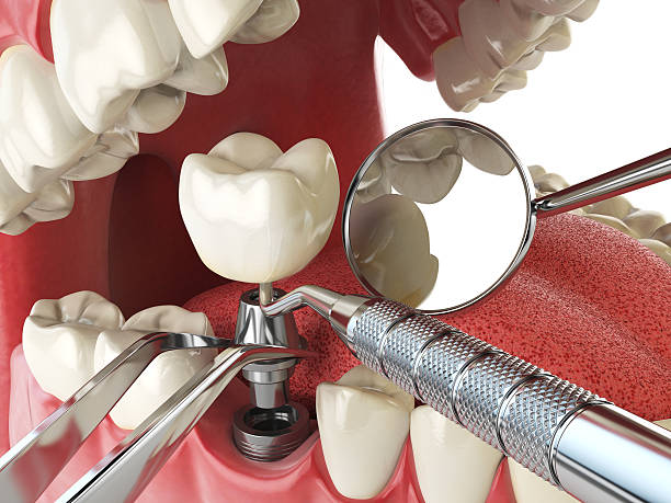 Best Emergency Root Canal Treatment in Excelsior Springs, MO